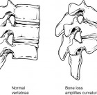 osteoporosis