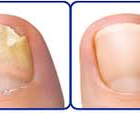 uñas dañadas